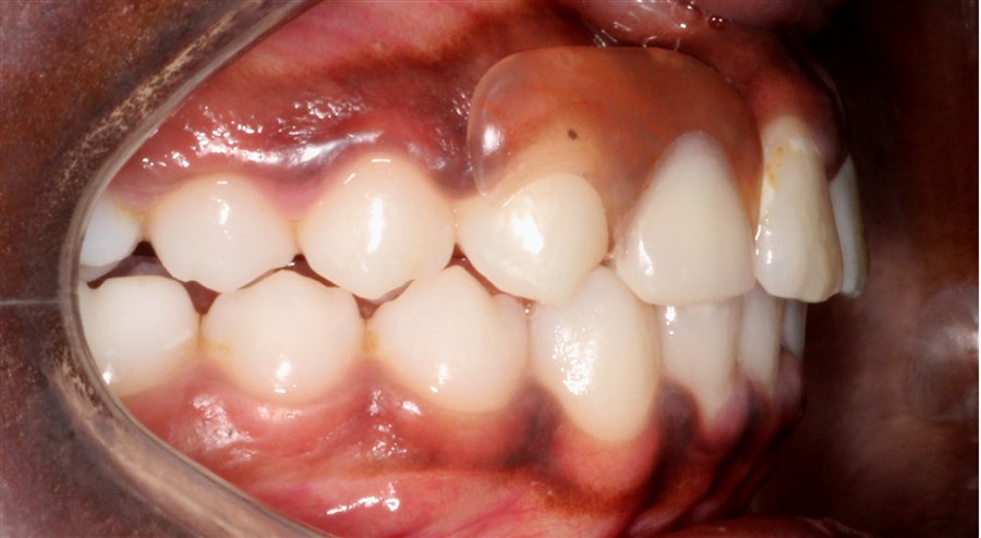 After treatment, case 1, side view