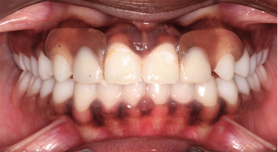After treatment, case 1, front view
