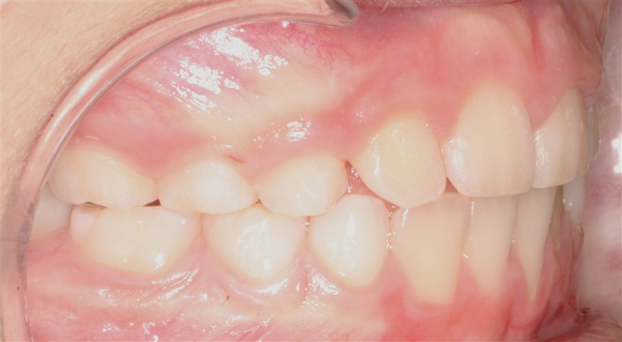 After treatment, case 2, side view