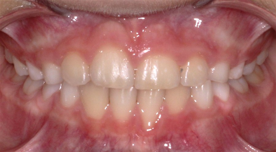 After treatment, case 2, front view