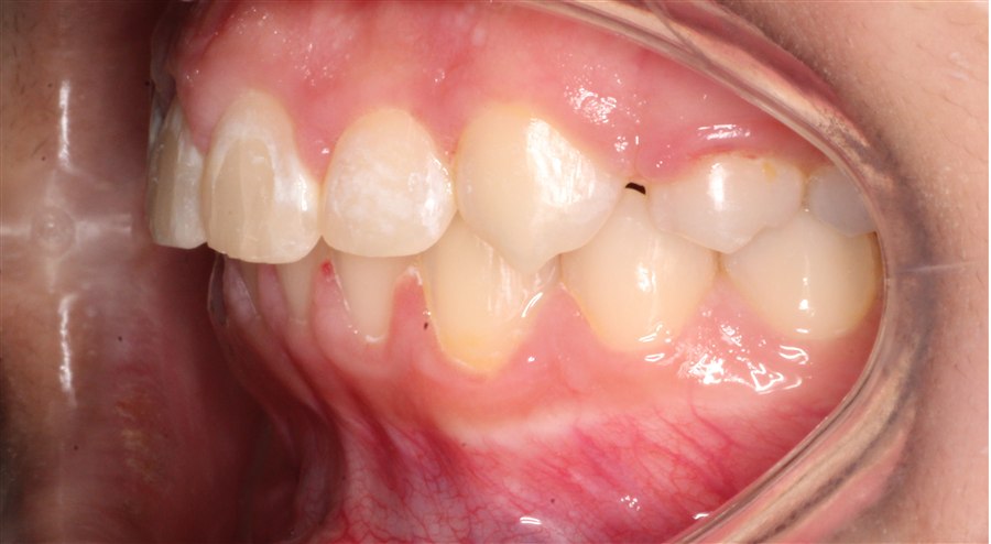 After treatment, case 3, side view