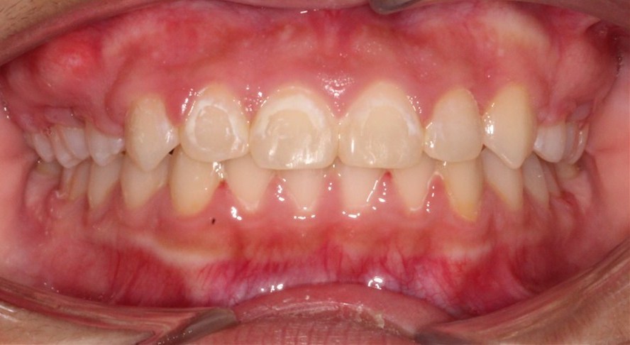 After treatment, case 3, front view