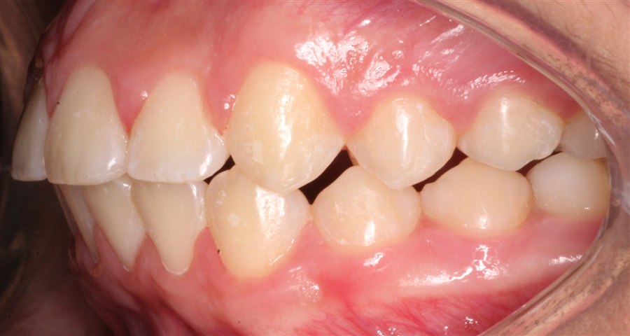 After treatment, case 4, side view