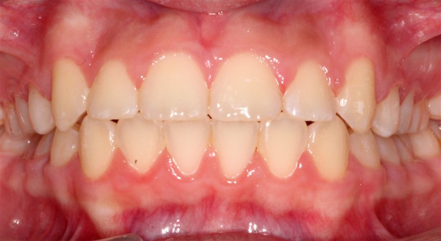 After treatment, case 4, front view