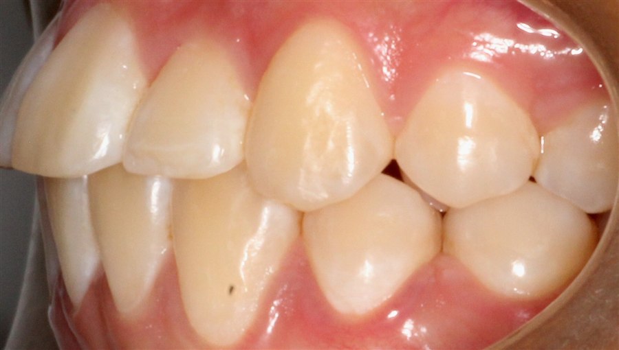 After treatment, case 5, side view