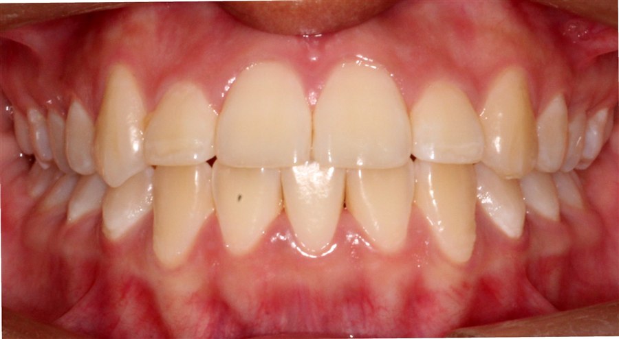After treatment, case 5, front view