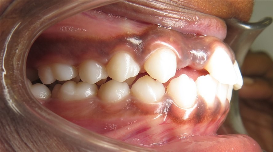 Before treatment, case 1, side view