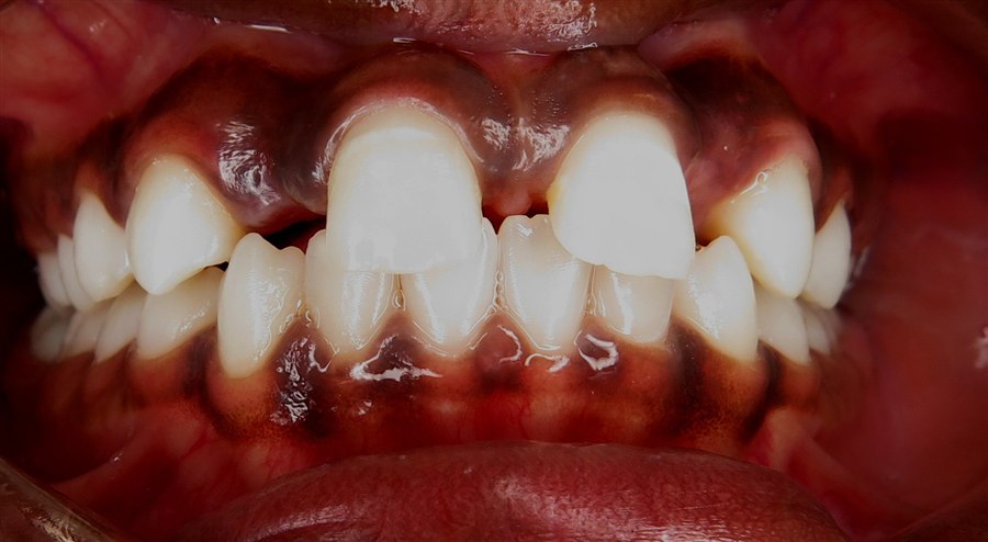 Before treatment, case 1, front view