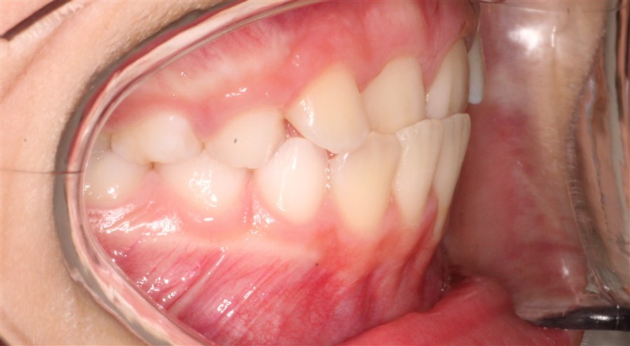 Before treatment, case 2, side view