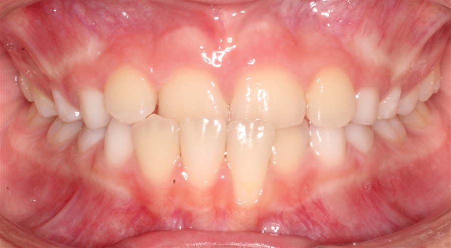 Before treatment, case 2, front view