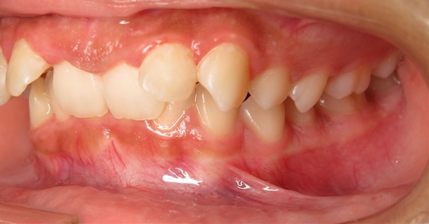 Before treatment, case 3, side view