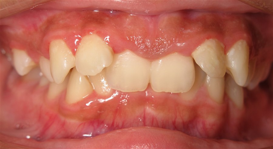 Before treatment, case 3, front view