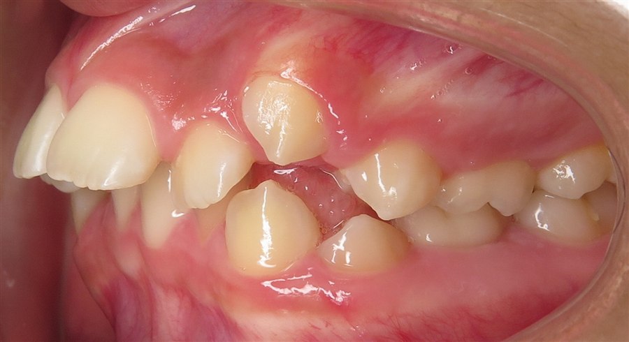 Before treatment, case 4, side view