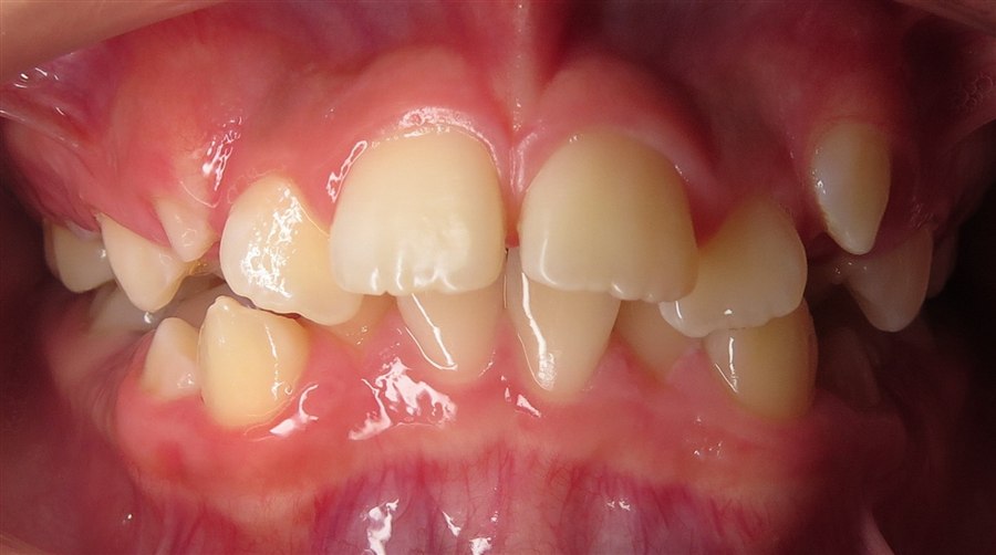 Before treatment, case 4, front view