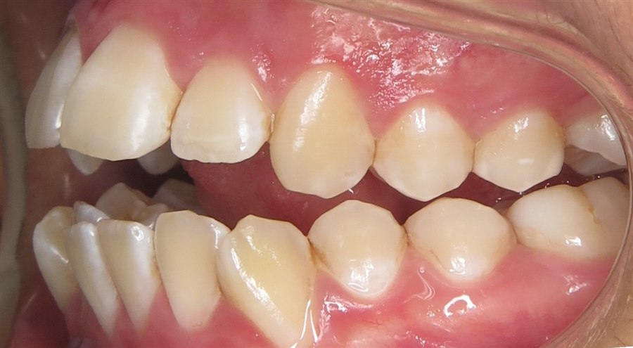 Before treatment, case 5, side view