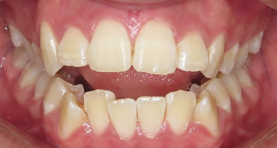 Before treatment, case 5, front view